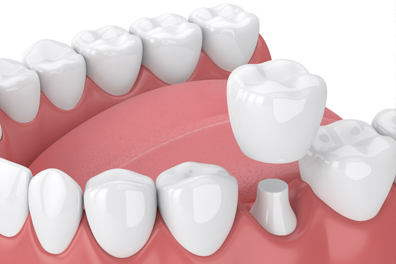 Dental Crowns in Lilburn